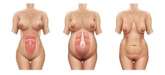 بزرگ ماندن شکم پس از زایمان ، شکم بعد از زایمان ، پوست شکم در بارداری ، کوچک کردن شکم پس از زایمان