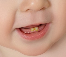 برای جلوگیری از تغییر رنگ دندان؛ قطره آهن را در ته گلوی کودک بچکانید