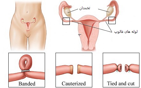بستن لوله های زنان - توبکتومی