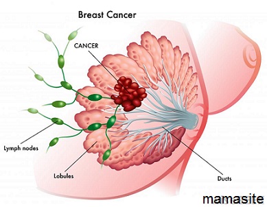 سرطان پستان در یائسگی