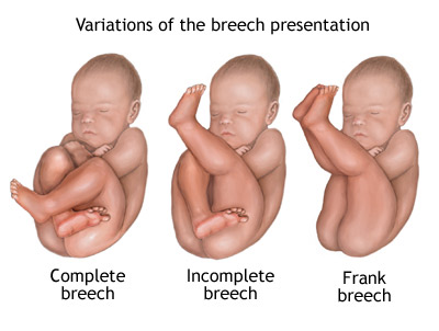 جنین بریچ- وضعیت بریچ- جنین بریچ در هفته 38
