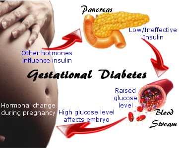 دیابت بارداری یا دیابت در بارداری
