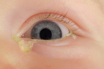 مراقبت از چشم نوزاد