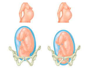 زایمان طبیعی ، سر جنین داخل لگن ، خالی شدن سر شکم در بارداری ، مراحل زایمان ، مامای همراه ، درد زایمان آنگاژمان