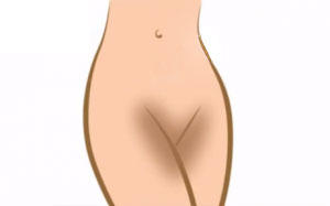 تیرگی لبهای تناسلی - تیرگ لبهای کوچک واژن