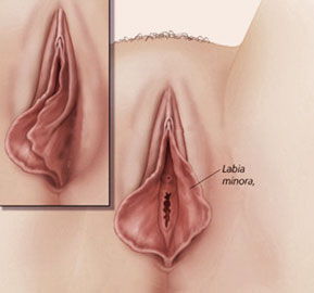 عمل جراحی لابیاپلاستی یک عمل زیبایی واژن است